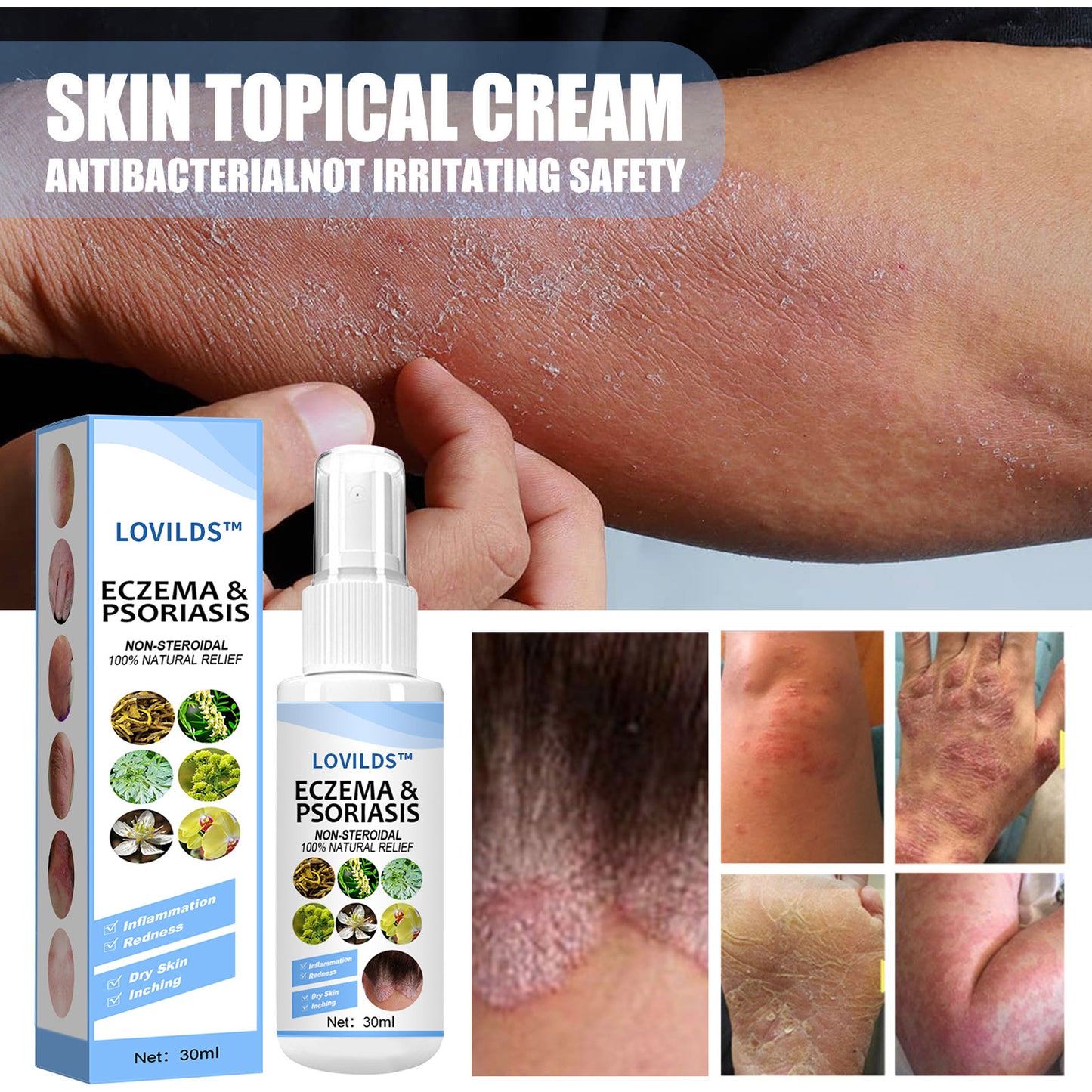 LOVILDS™ Eczema & Psoriasis Relief Spray